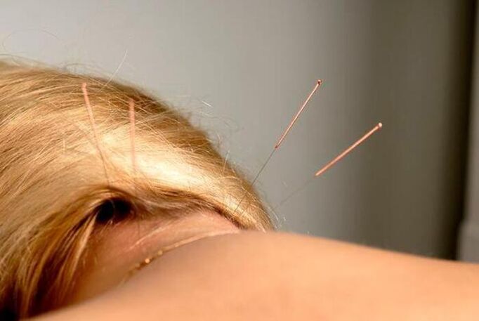 acupuncture le haghaidh osteochondrosis